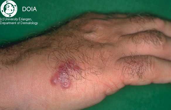 Herpetic Whitlow in Adults: Condition, Treatments, and ...